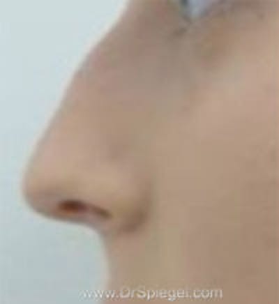 Rhinoplasty Before & After Gallery - Patient 197584 - Image 1
