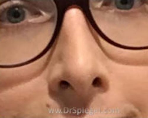 Rhinoplasty Before & After Gallery - Patient 337579 - Image 2