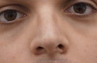 Rhinoplasty Before & After Gallery - Patient 311323 - Image 1