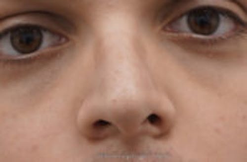 Rhinoplasty Before & After Gallery - Patient 311323 - Image 1