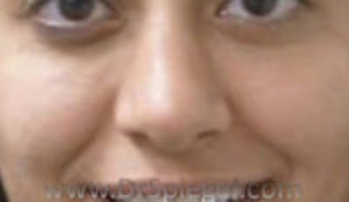Rhinoplasty Before & After Gallery - Patient 836504 - Image 1