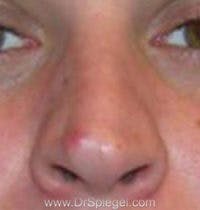 Rhinoplasty Before & After Gallery - Patient 637694 - Image 1