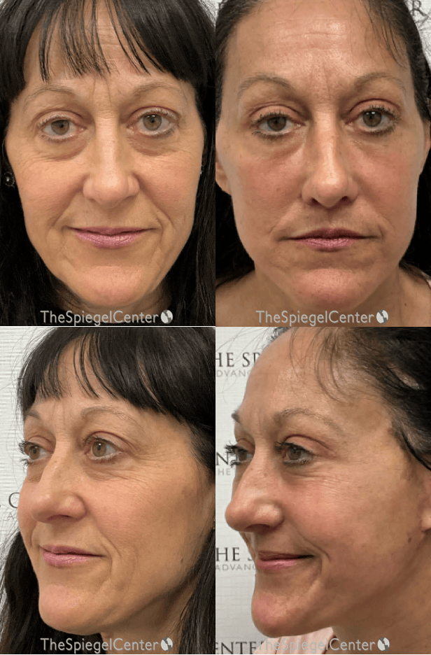 Facelift Before & After Gallery - Patient 315449 - Image 1