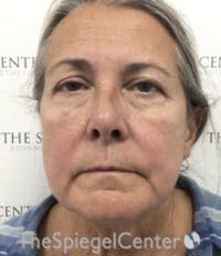 Facelift Before & After Gallery - Patient 211060 - Image 1