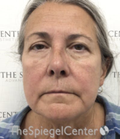 Facelift Before & After Gallery - Patient 211060 - Image 1