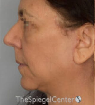 Facelift Before & After Gallery - Patient 361330 - Image 4