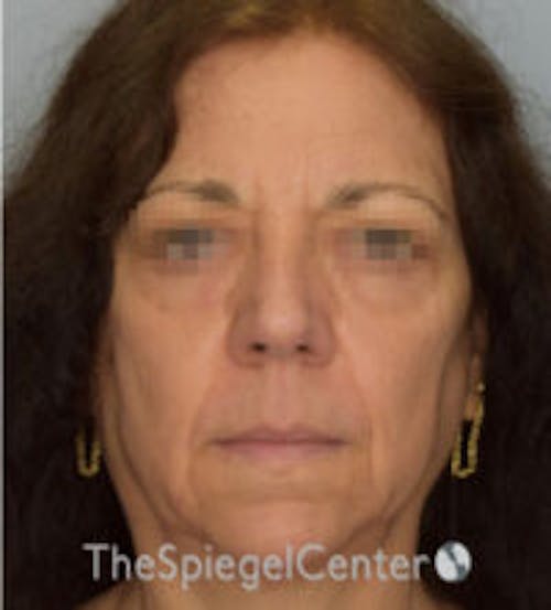 Facelift Before & After Gallery - Patient 361330 - Image 1
