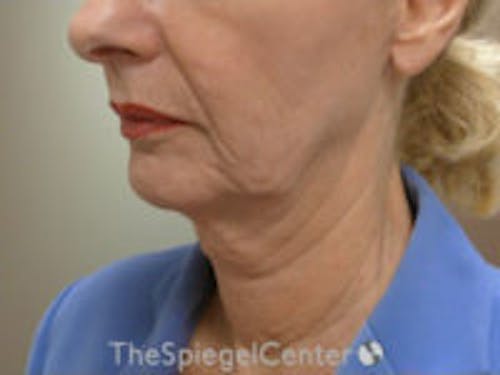 Neck Lift Before & After Gallery - Patient 169630 - Image 3