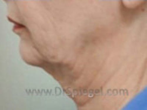 Neck Lift Before & After Gallery - Patient 169630 - Image 1