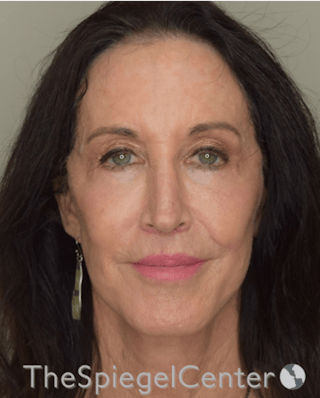 Facelift Before & After Gallery - Patient 857757 - Image 2