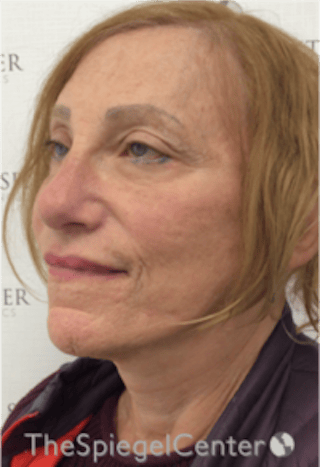 Facelift Before & After Gallery - Patient 227067 - Image 4