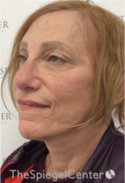 Facelift Before & After Gallery - Patient 227067 - Image 4