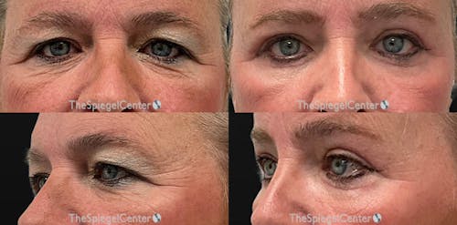 Blepharoplasty Before & After Gallery - Patient 163799 - Image 1