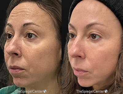 Morpheus8 Before & After Gallery - Patient 273047 - Image 1