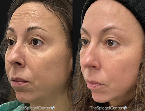 Morpheus8 Before & After Gallery - Patient 273047 - Image 1