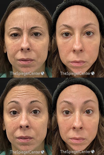 Botox / Dysport / Jeuveau / Xeomin Before & After Gallery - Patient 655653 - Image 1