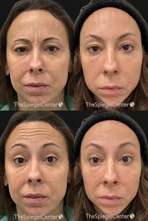 Botox / Dysport / Jeuveau / Xeomin Before & After Gallery - Patient 655653 - Image 1