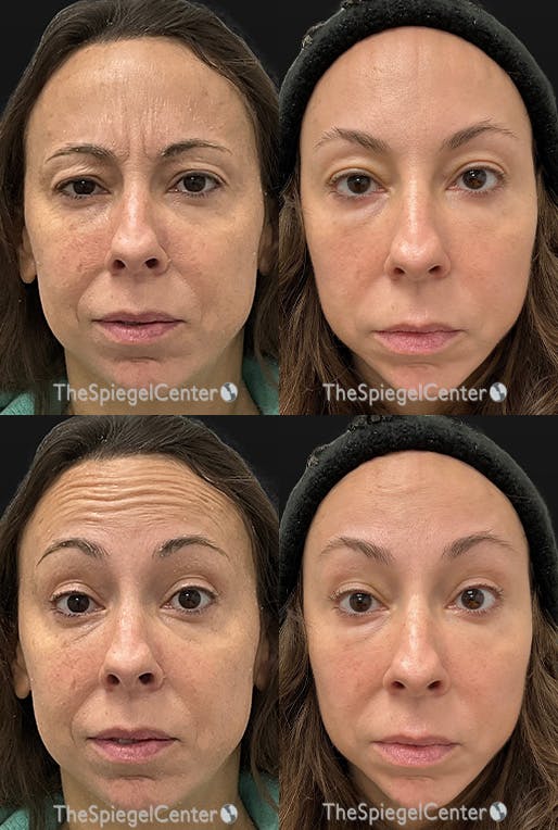 Botox / Dysport / Jeuveau / Xeomin Before & After Gallery - Patient 655653 - Image 1