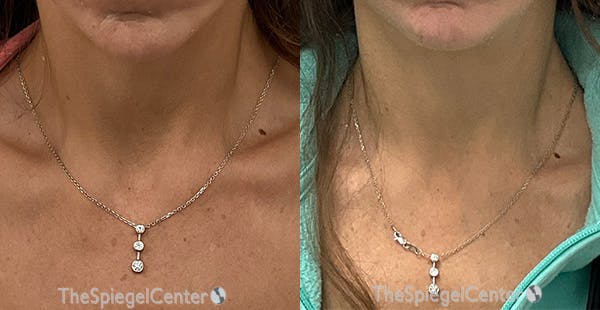 Neck Botox Before & After Gallery - Patient 371716 - Image 1