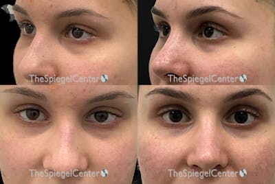 Rhinoplasty Before & After Gallery - Patient 190751 - Image 1