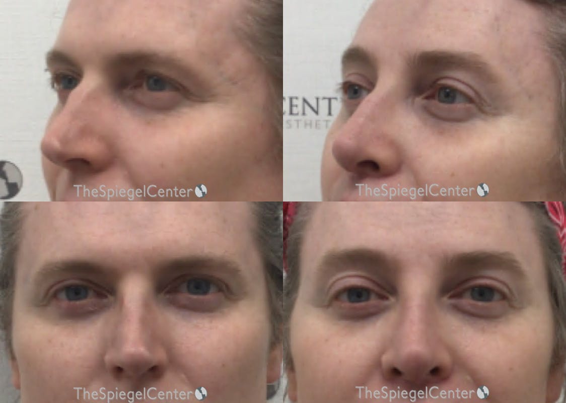 Rhinoplasty Before & After Gallery - Patient 171868 - Image 1