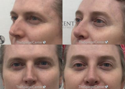 Rhinoplasty Before & After Gallery - Patient 171868 - Image 1