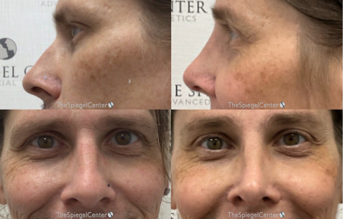 Rhinoplasty Before & After Gallery - Patient 350651 - Image 1