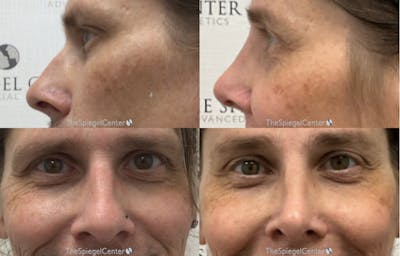 Rhinoplasty Before & After Gallery - Patient 350651 - Image 1