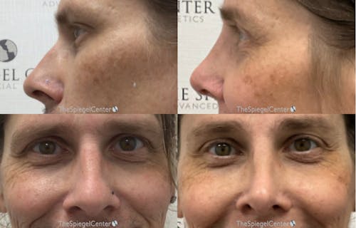 Rhinoplasty Before & After Gallery - Patient 350651 - Image 1
