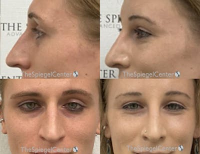 Rhinoplasty Before & After Gallery - Patient 332371 - Image 1