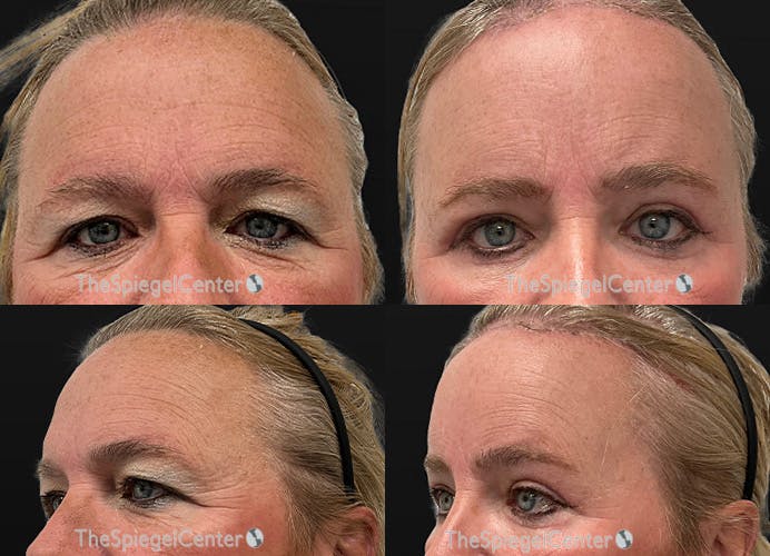 FFS Forehead Contouring Before & After Gallery - Patient 685585 - Image 1