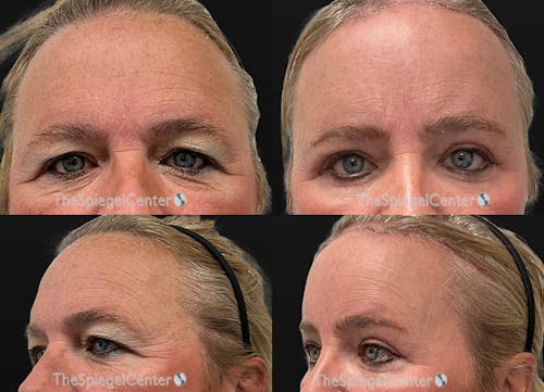 FFS Forehead Contouring Before & After Gallery - Patient 685585 - Image 1