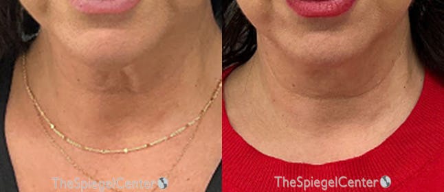 Neck Botox Before & After Gallery - Patient 397584 - Image 1