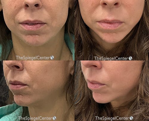 Nasolabial Fold Filler Before & After Gallery - Patient 217134 - Image 1