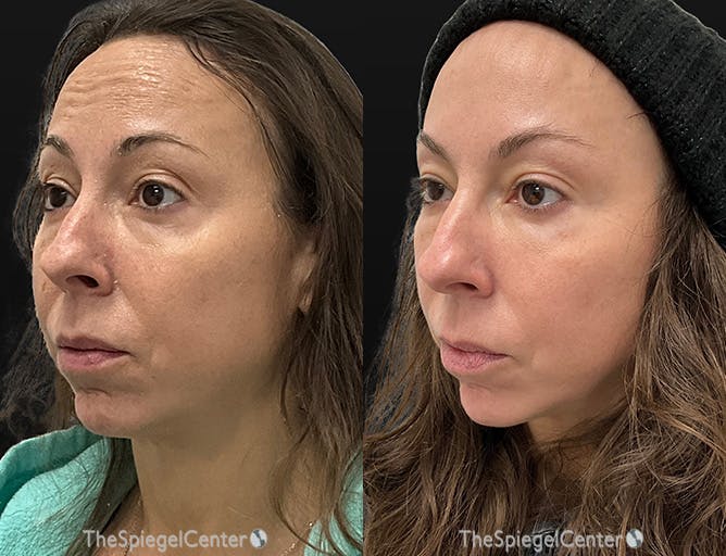 IPL / Intense Pulse Light Before & After Gallery - Patient 403627 - Image 1