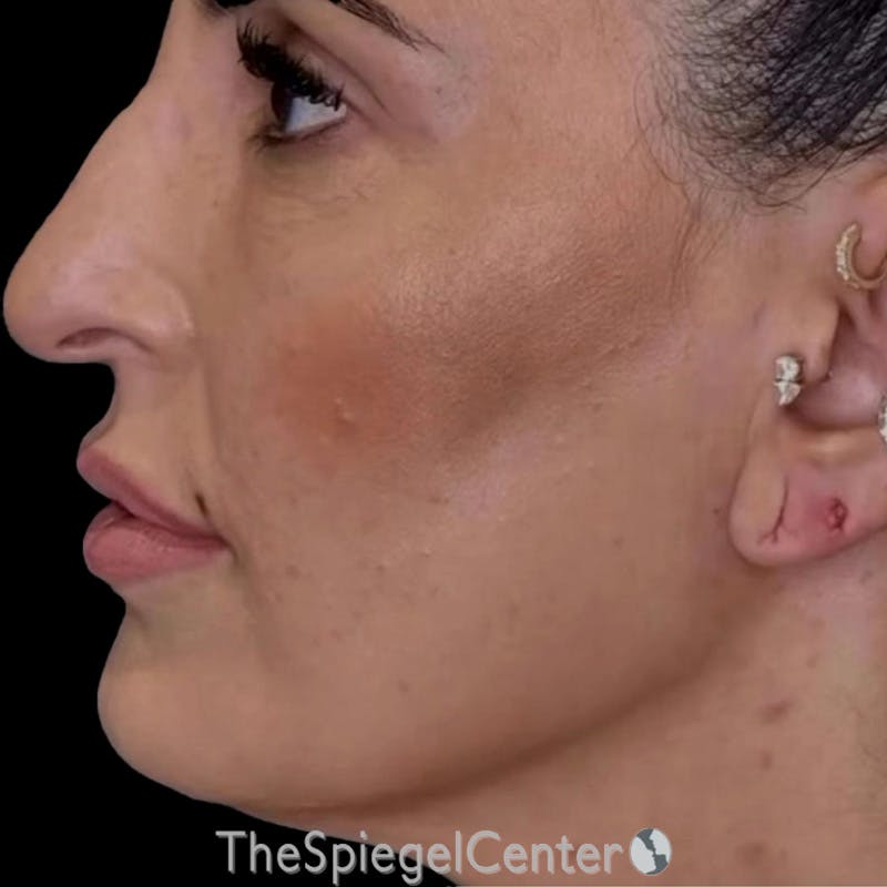 Junera (EraLift) Before & After Gallery - Patient 114346 - Image 1