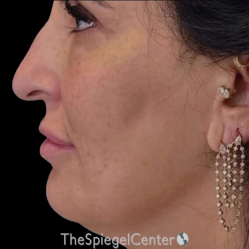 Junera (EraLift) Before & After Gallery - Patient 114346 - Image 2