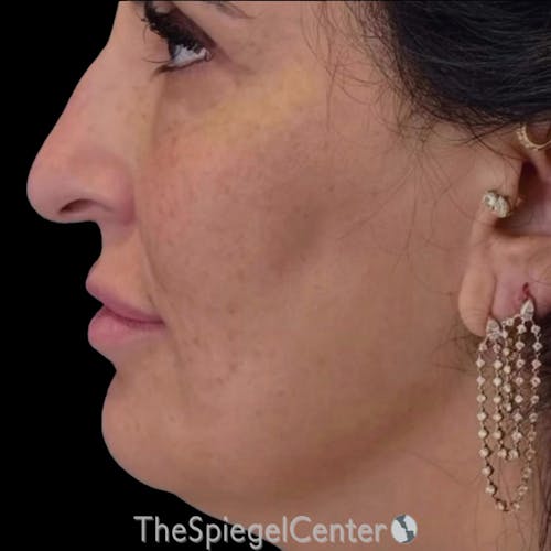 Junera (EraLift) Before & After Gallery - Patient 114346 - Image 2