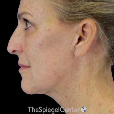 Junera (EraLift) Before & After Gallery - Patient 332387 - Image 1