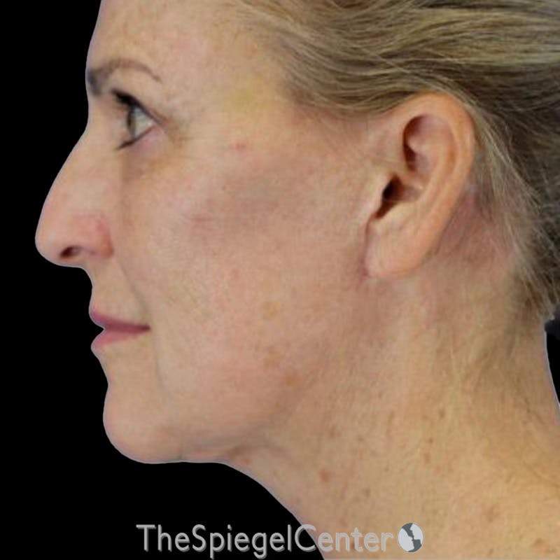 Junera (EraLift) Before & After Gallery - Patient 332387 - Image 1