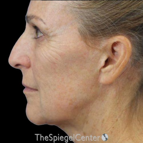 Junera (EraLift) Before & After Gallery - Patient 332387 - Image 2