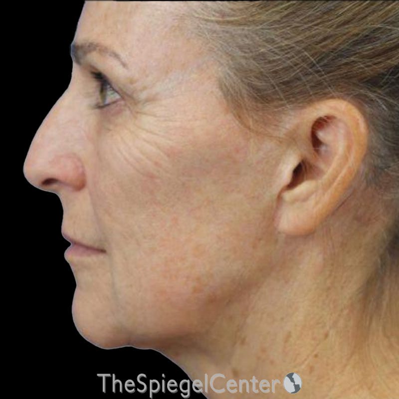Junera (EraLift) Before & After Gallery - Patient 332387 - Image 2
