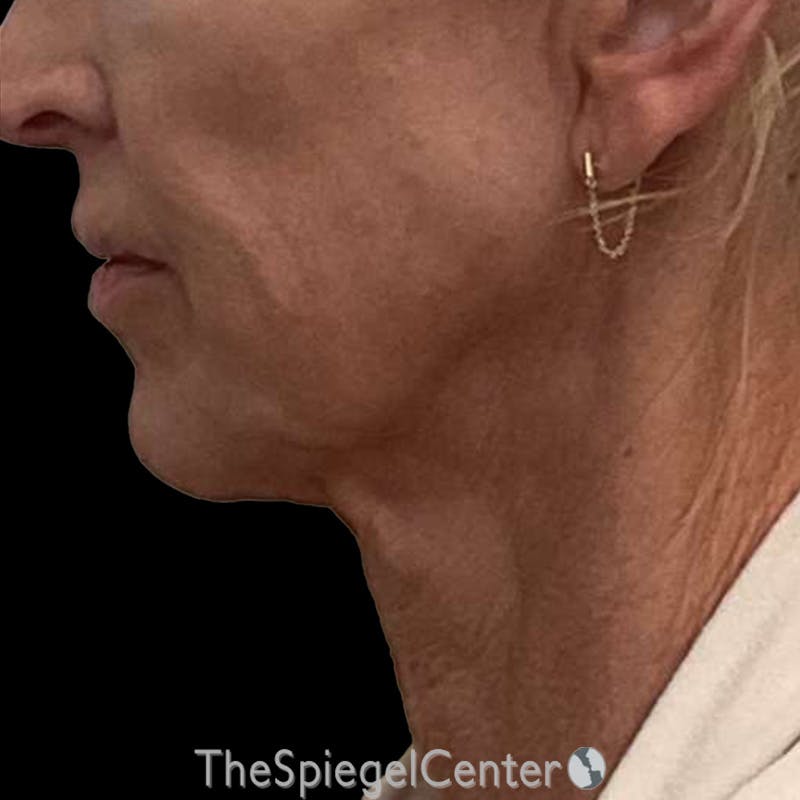 Junera (EraLift) Before & After Gallery - Patient 506294 - Image 1