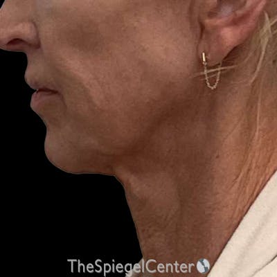 Junera (EraLift) Before & After Gallery - Patient 506294 - Image 1