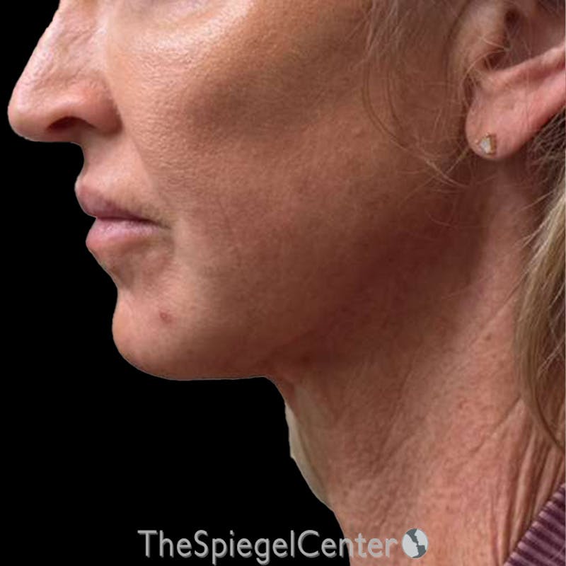 Junera (EraLift) Before & After Gallery - Patient 506294 - Image 2