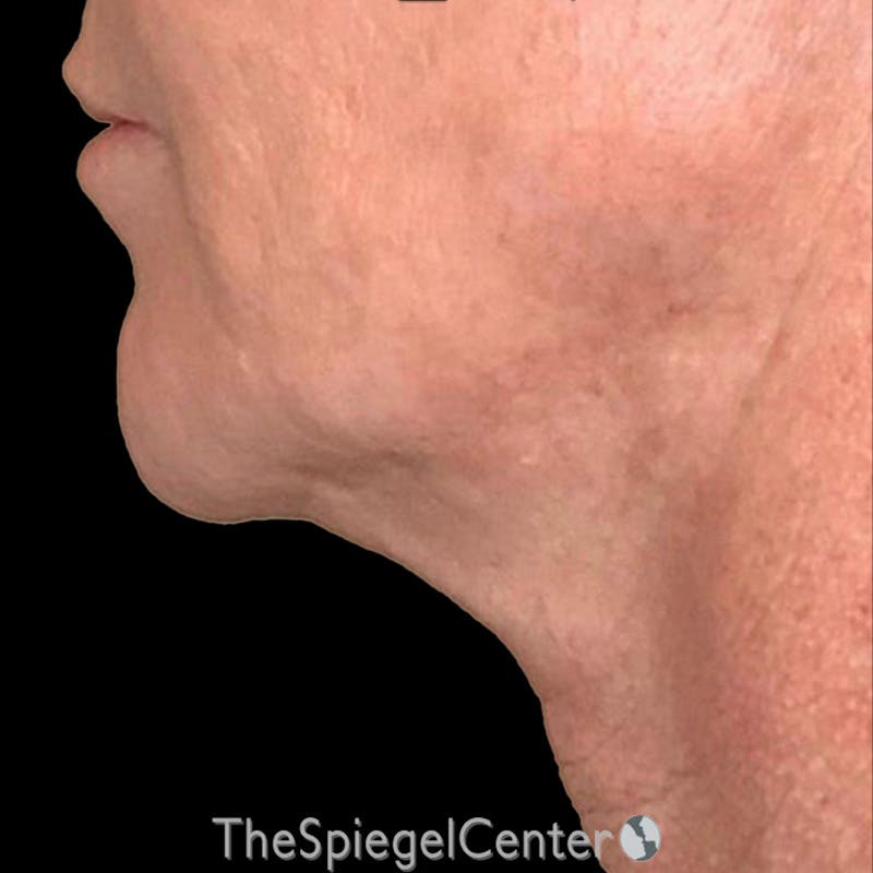 Junera (EraLift) Before & After Gallery - Patient 452222 - Image 2