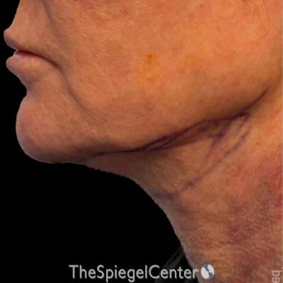 Junera (EraLift) Before & After Gallery - Patient 452222 - Image 1