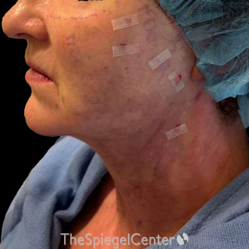 Junera (EraLift) Before & After Gallery - Patient 328734 - Image 2