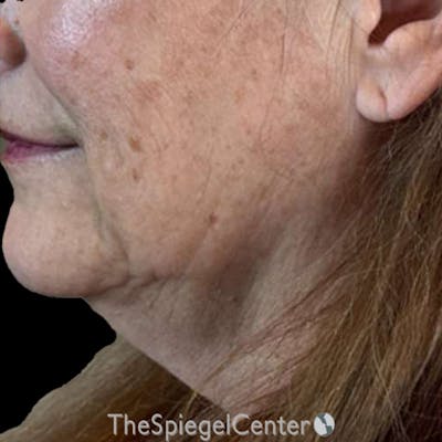 Junera (EraLift) Before & After Gallery - Patient 344086 - Image 1