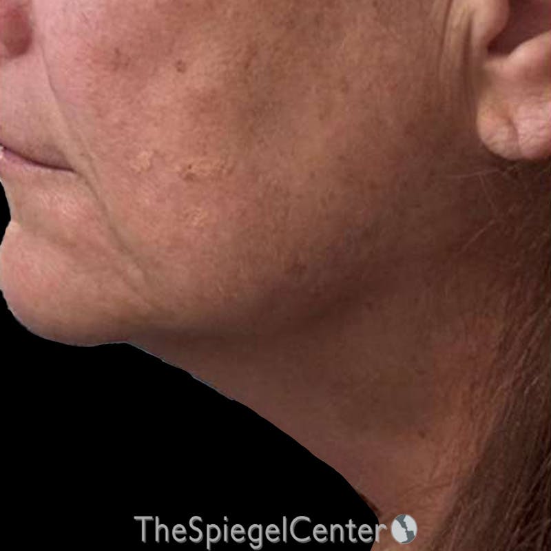 Junera (EraLift) Before & After Gallery - Patient 344086 - Image 2